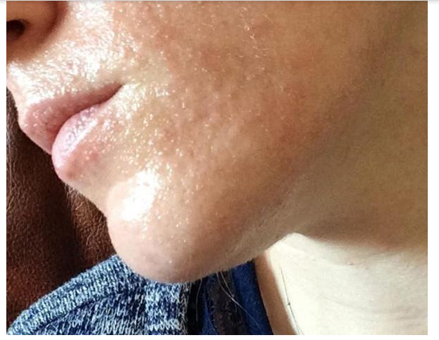 Nguyên nhân và cách chăm sóc da mặt sần sùi lỗ chân lông to
