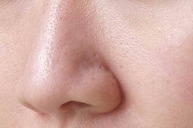 5 cách trị mụn li ti, da mặt sần sùi nhiều mụn cám hiệu quả sau 1 tuần lễ